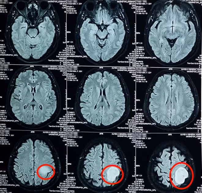 Hình ảnh khối u não của bệnh nhân qua kết quả chụp MRI