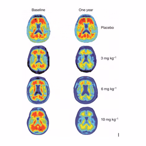 Những mảng bám amyloid (trái) được tống khứ sạch sau khi dùng thuốc Aducanumab (phải).