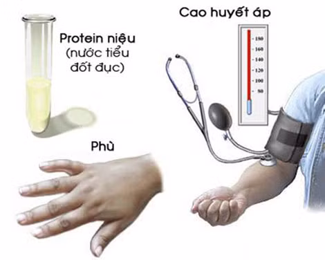 Tam chứng tiền sản giật. Tam chứng tiền sản giật.