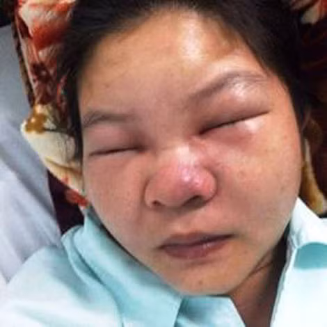 Một bệnh nhân khi vào viện.