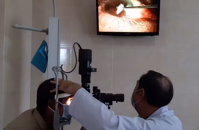 Bác sĩ thực hiện gấp dị vật kết đông từ keo dán sắt trong mắt bệnh nhân.