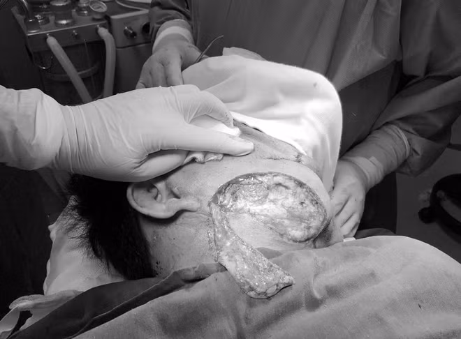 Những lát dao với quyết tâm làm thay đổi “mặt ma” của anh Mến.