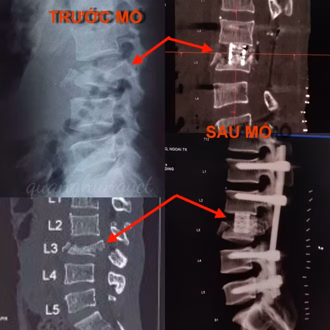 Hình ảnh đốt sống trước và sau phẫu thuật.