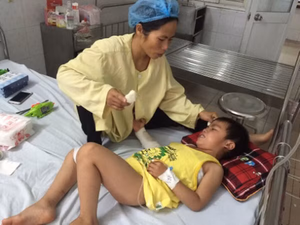 Chị Hương đang chăm sóc con trai tại Viện Bỏng quốc gia.