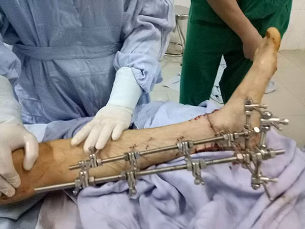 Anh Nguyễn Văn Thìn được các bác sĩ phẫu thuật nối ghép lại chân bị đứt lìa do trúng lưỡi máy cắt cỏ.