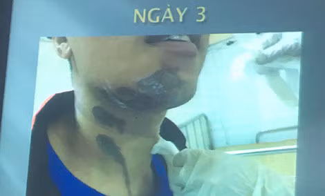 Vùng da bệnh nhân H. khi bị hoá chất văng phải vào ngày thứ 3 đã trở nên có màu đen sẫm. Vùng da bệnh nhân H. khi bị hoá chất văng phải vào ngày thứ 3 đã trở nên có màu đen sẫm.
