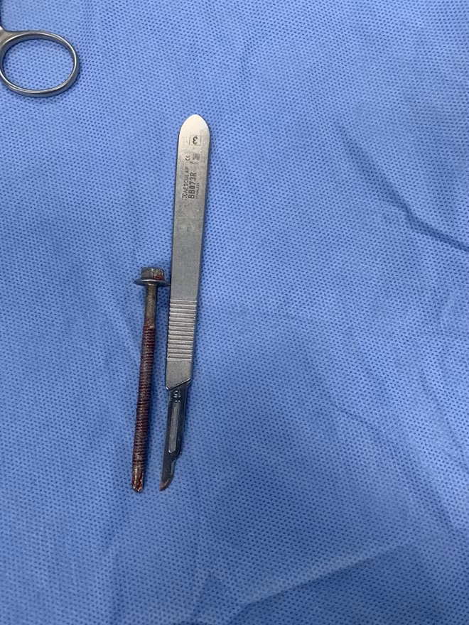 Dị vật được lấy ra