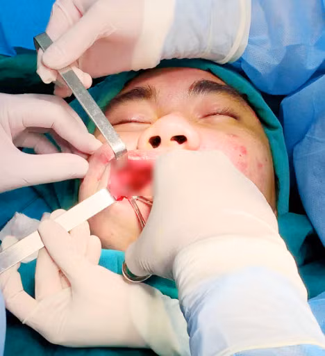 Phẫu thuật nạo slicon ở má bệnh nhân Phẫu thuật nạo slicon ở má bệnh nhân