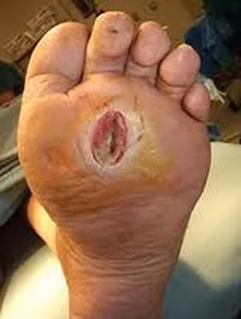 Loét dần đến hoại tử, bàn chân ở một bệnh nhân bị tiểu đường do vi khuẩn streptoCoccus SPP. Loét dần đến hoại tử, bàn chân ở một bệnh nhân bị tiểu đường do vi khuẩn streptoCoccus SPP.