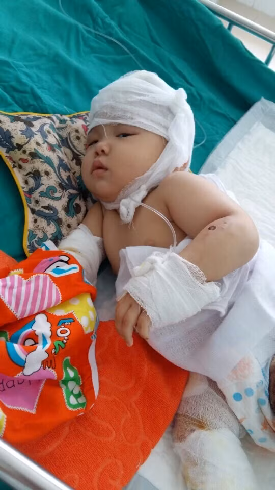 Ba mẹ con chị Duyên đang cần sự hỗ trợ của cộng đồng để có tiền phẫu thuật cấy ghép da. Hiện tại, tiền điều trị cho mỗi người lên tới 15 triệu một ngày. Ba mẹ con chị Duyên đang cần sự hỗ trợ của cộng đồng để có tiền phẫu thuật cấy ghép da. Hiện tại, tiền điều trị cho mỗi người lên tới 15 triệu một ngày.
