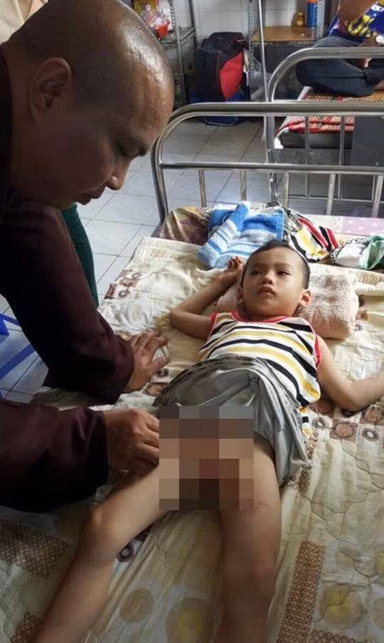 Cháu Long bị bỏng hết dương vật do bị tô hủ tiếu nóng đổ vào người.