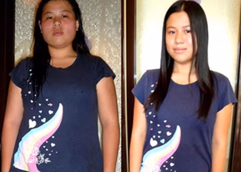 Sau 1 tháng nhĩ châm, cô gái này đã giảm được 3kg.
