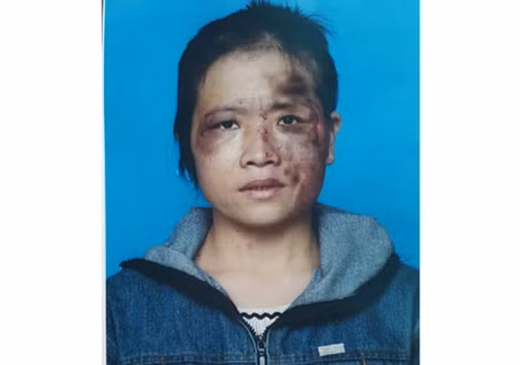 Chị Hồng bị chồng tra tấn dã man và ảnh chi đang điều trị tại bệnh viện ( Ảnh: Nạn nhân cung cấp).