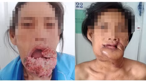Bệnh nhân H. trước và sau khi được phẫu thuật thành công U bướu môi dưới. (ảnh BV cung cấp)