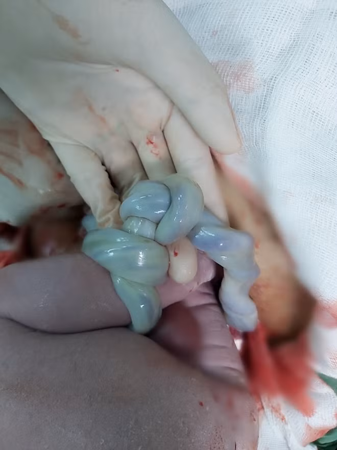Sau khi bé chào đời, các BS phát hiện cháu bị dây rốn thắt nút.