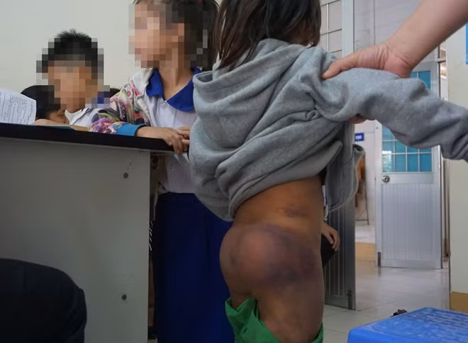 Các cháu nhỏ bị chị đánh bầm tím người