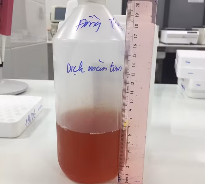 Các BS hút ra 700ml dịch từ màng ngoài tim của bệnh nhân Đ.