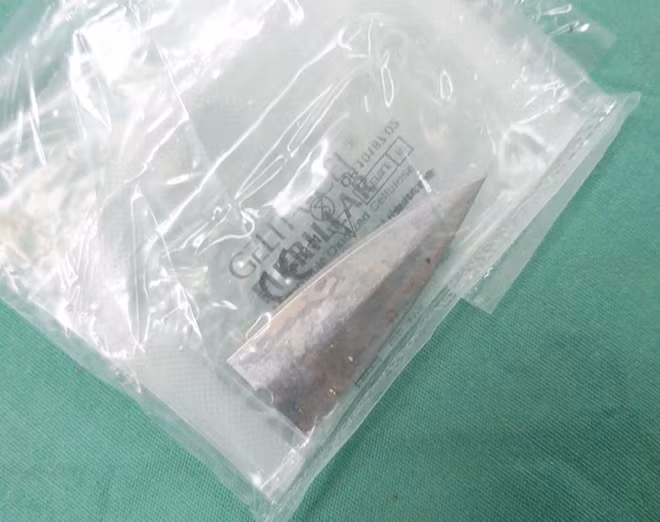 Các BS lấy mui dao ra khỏi người bệnh nhân T.