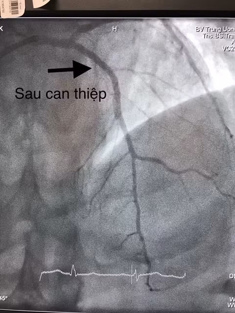 Và sau khi can thiệp thành công cho bệnh nhân.