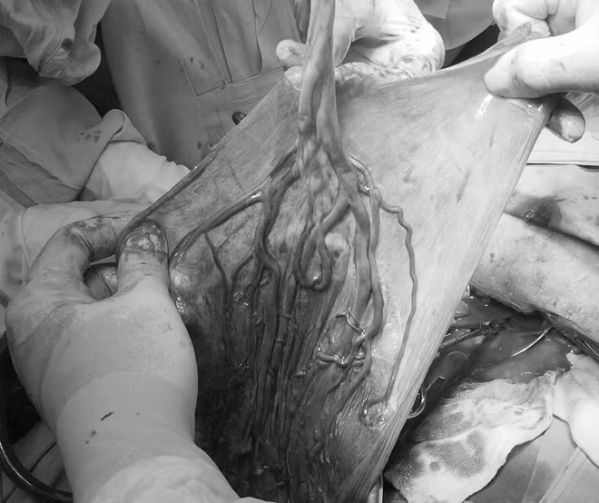 Dây rốn bám màng hiếm gặp và rất nguy hiểm cho thai nhi.