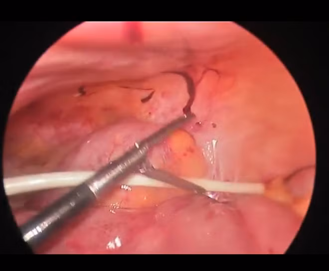 Các BS đang nội soi lấy ống nhựa ra khỏi bụng bệnh nhân.