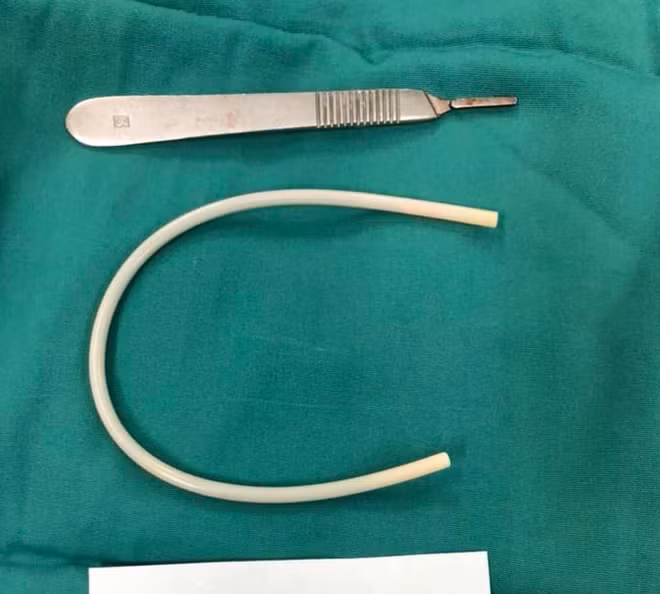 Ống nhựa có đường kính 6mm, dài 30cm được lấy ra khỏi người bệnh nhân T.