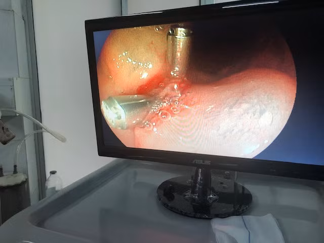 Hình ảnh BS dùng kịp clip cầm máu cho bệnh nhân.