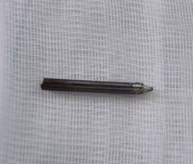 Chiếc đinh khoảng 3cm được lấy ra khỏi hốc mắt bệnh nhân.