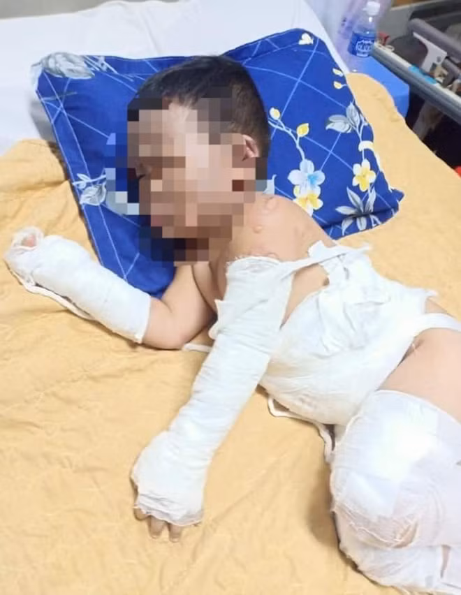 Cháu bé đang điều trị bỏng nặng