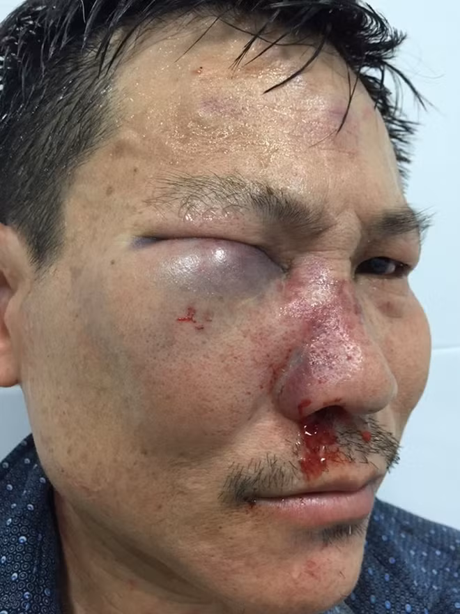 Ông Hưng bị thương tích vùng mặt