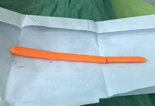 Cán muỗng nhựa bị gãy 3 đoạn mà các BS lấy ra từ mắt bệnh nhân Tỏa.
