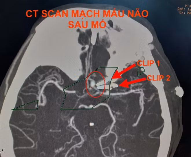Và sau khi phẫu thuật thành công.