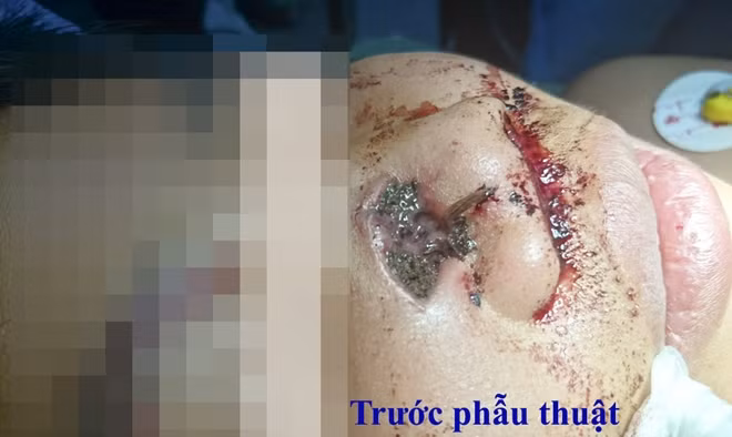 Cháu Đạt trước khi phẫu thuật.