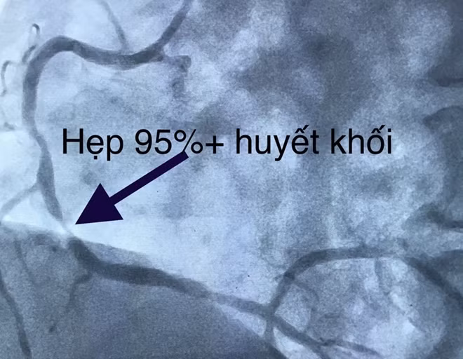 Hình ảnh bệnh nhân bị hẹp động mạch.