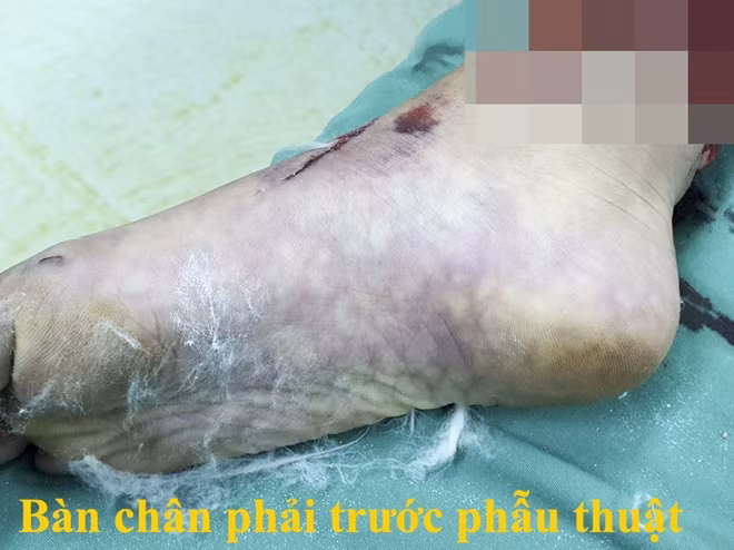 Bàn chân phải của cháu Hân trước khi phẫu thuật.