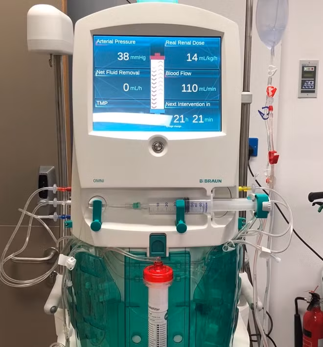 Sản phụ Ngân được lọc máu 41 giờ liên tục.