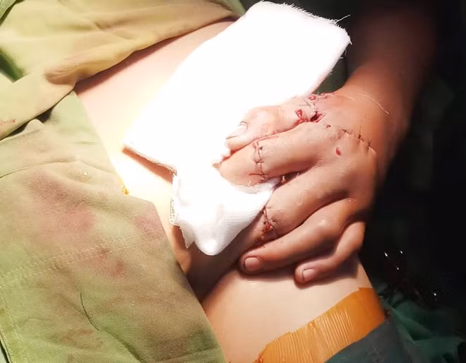 Và sau khi phẫu thuật thành công cho bệnh nhi.