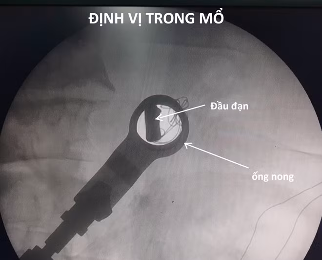 Các BS định vị đầu đạn trong lúc mổ.