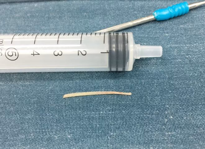 Xương cá dài 3cm được các BS lấy ra khỏi cổ bệnh nhi.