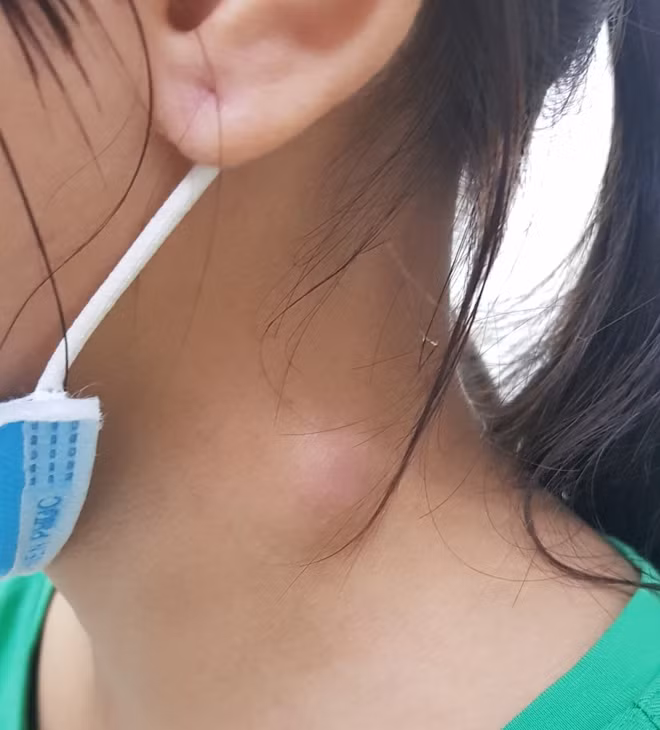 Vùng cổ trái bệnh nhi trước khi phẫu thuật có khối sưng.