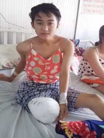 Và buộc phải cắt bỏ chân tại Bệnh viện Chợ Rẫy TP Hồ Chí Minh.