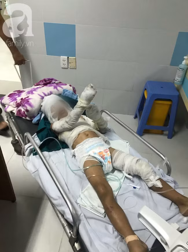 Bé N.T.V hiện đang được điều trị tại Khu Bỏng thuộc Khoa Bỏng chỉnh trực, BV Nhi Đồng 2.