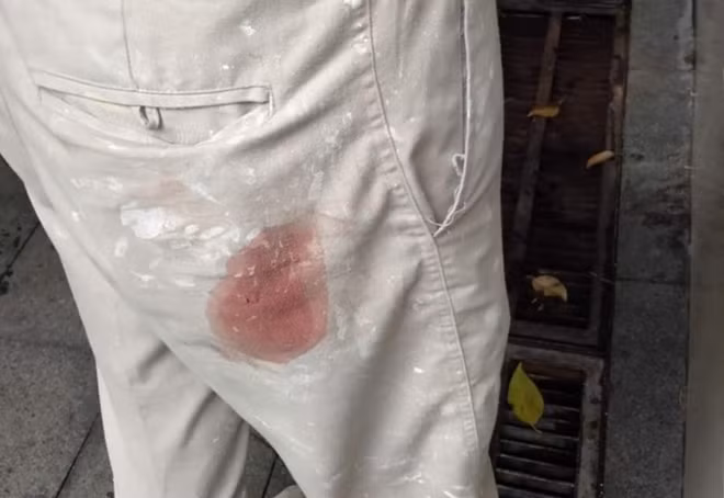 Anh V. bị trúng đạn ở vùng mông khi đang thi công.