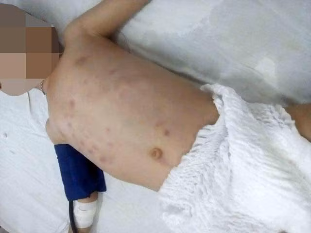 Cháu L. được cấp cứu tại Bệnh viện sau khi bị đối tượng Nguyễn Văn Hiếu bạo hành dã man.