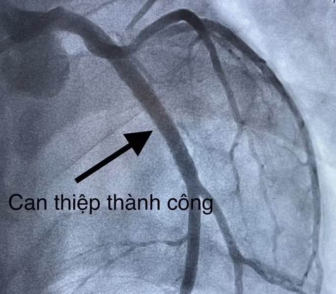 Và sau khi can thiệp thành công.