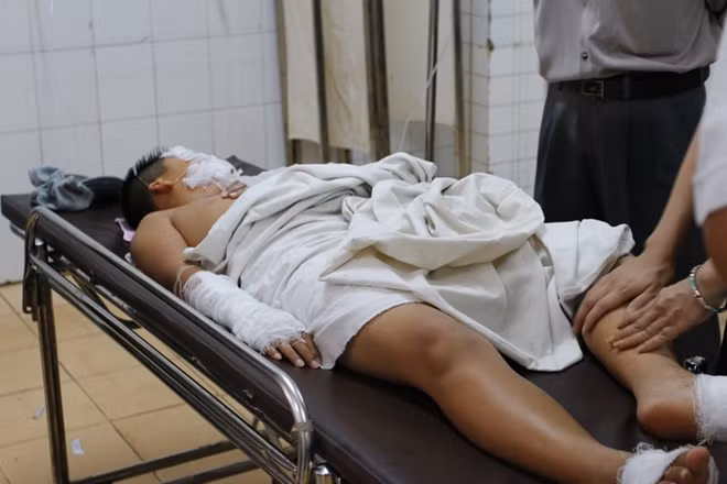 Em Doãn Sơn Tùng bị bỏng nặng nhất với bỏng vùng mặt, cẳng tay và bụng