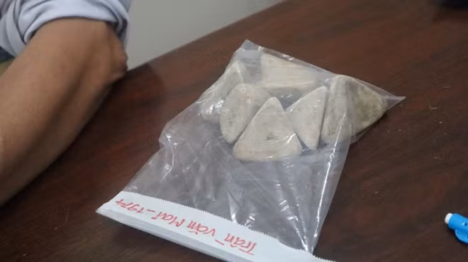 Các viên sỏi bàng quang kích thước lớn