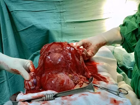 Bóc tách khối u xơ tử cung “khủng” ra khỏi người bệnh nhân 