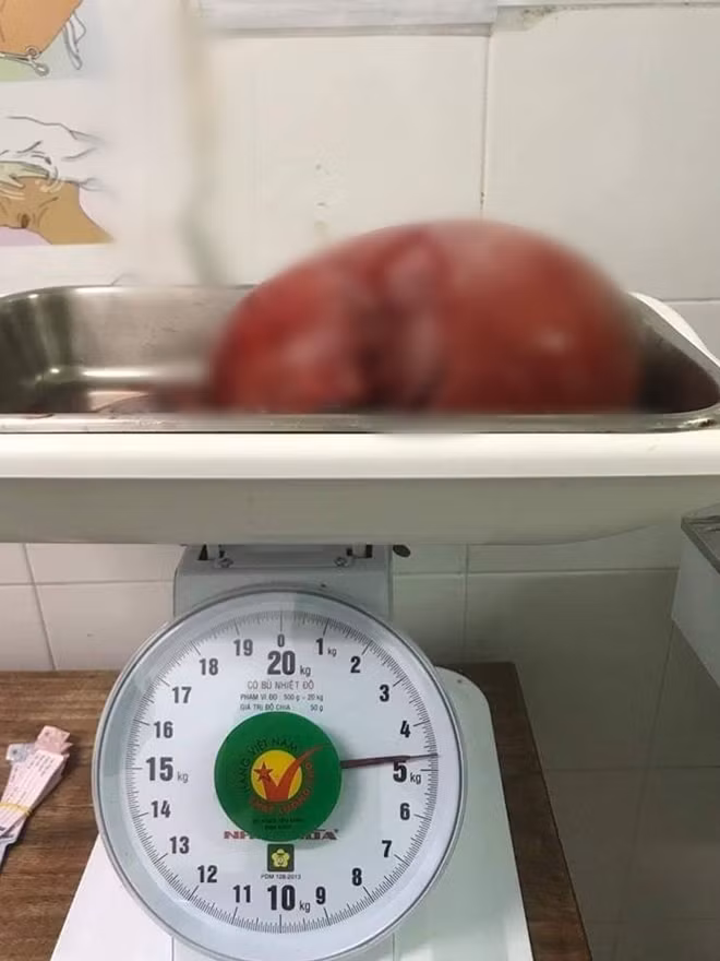 Khối u xơ tử cung nặng gần 5kg được đưa ra khỏi người bệnh nhân L.