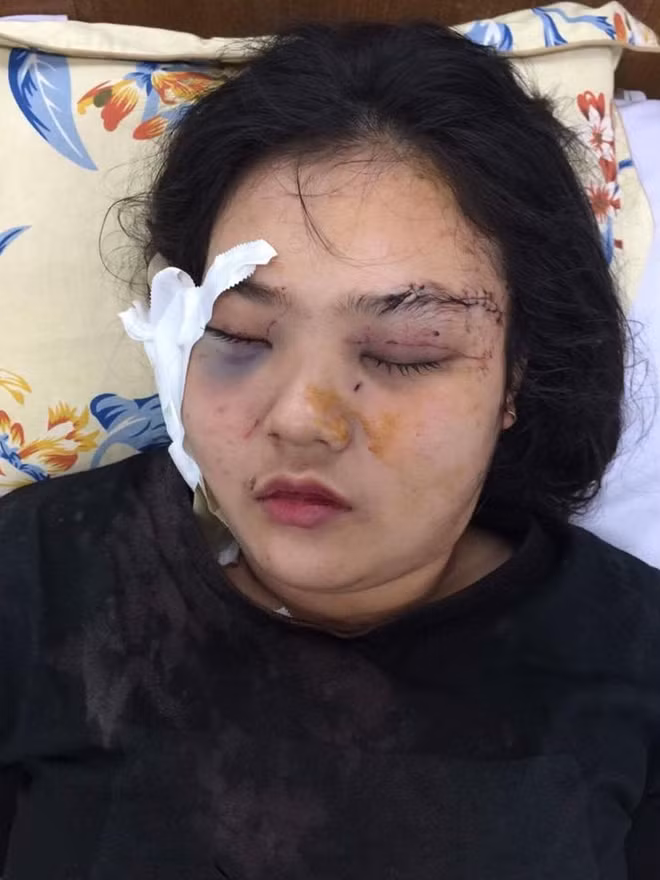 Nhiều vết thương trên người thiếu nữ 16 tuổi, nặng nhất là vùng đầu